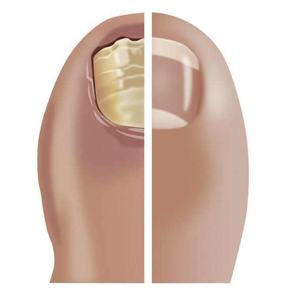 Medonail Nagelpflege bei Pilzbefall Medosan