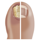 Medonail Nagelpflege bei Pilzbefall Medosan